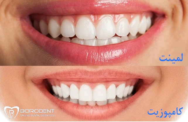 تفاوت لمینت و کامپوزیت دندان